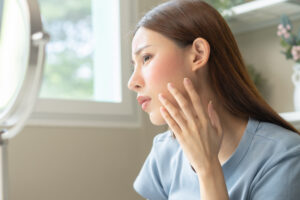 臉部泛紅以為是天然腮紅？小心是「玫瑰斑」亂擦類固醇恐更惡化！