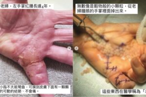 密集恐懼不要看！老婦手掌流出一堆「米粒」網驚呼：看到吐了