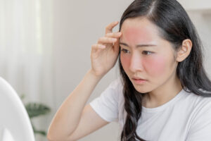 臉紅、刺痛恐是「玫瑰斑」作祟 醫授5大保養原則