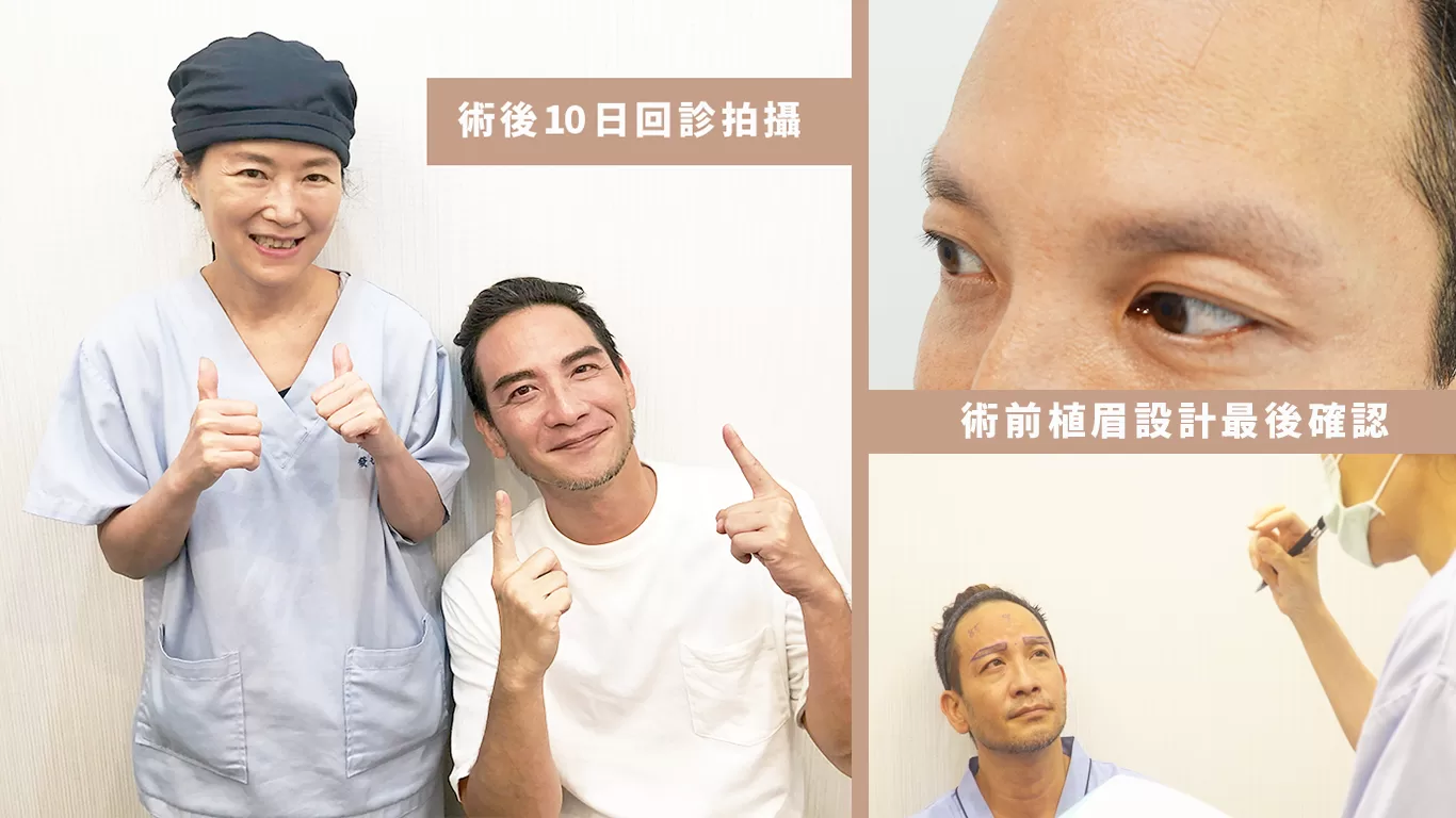 高山峰變MAN了！原來是找醫師「植眉」