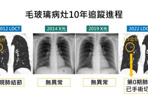 追蹤10年肺結節無異常  低劑量電能斷層揪出1.5公分腫瘤