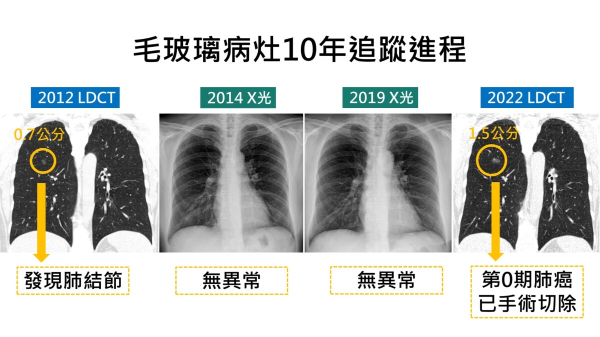 追蹤10年肺結節無異常  低劑量電能斷層揪出1.5公分腫瘤