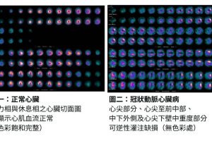 【張婉柔專欄】診斷癌症、心臟病 全靠「核子醫學科」