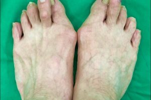 拇趾外翻棄運動10年 手術後重拾慢跑登山