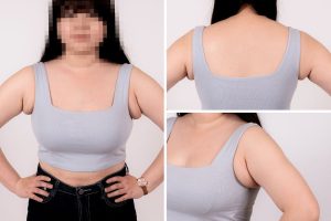 孕後減重副乳難消還伴隨刺痛？李咏馨醫師詳解乳腺刺激引發副乳腫脹成因