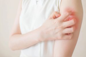 好不了的濕疹？乾癬？小心是罕見皮膚T細胞淋巴瘤