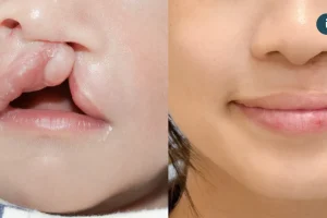 兔寶爸媽成長工作坊歷十屆有成 台灣唇顎裂產前診斷與產後治療典範轉移