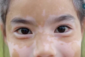 8歲女童患白斑症 醫病共同控制病情