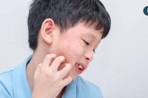 健保放寬口服小分子標靶藥給付至兩年 異位性皮膚炎迎來新曙光