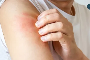 異膚治療不中斷！健保新藥想要「再上車」 病友該怎麼做？