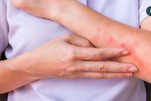 異位性皮膚炎治療新趨勢 生物製劑到生活調適 找回穩定自信