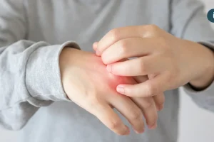 20歲男大生乾癬疾病延燒關節誤認痛風 醫籲提早控制發炎為關鍵