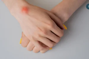 手腕腫塊別輕忽！腱鞘囊腫成因、好發族群與中醫調理重點一次看