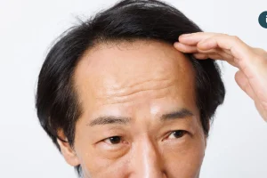 落髮不一定只和荷爾蒙有關 醫毛囊微環境失衡也可能讓髮量變少