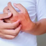 高溫、高濕讓濕疹反覆發作！醫師點名日常NG習慣 掌握4招安撫敏弱肌