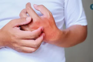 高溫、高濕讓濕疹反覆發作！醫師點名日常NG習慣 掌握4招安撫敏弱肌